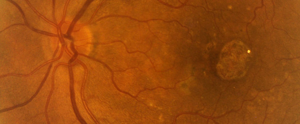 Degeneración macular