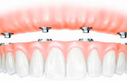 Dentures on implants.jfif