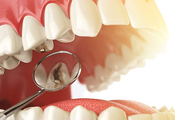 283068-trocar-restauracao-nos-dentes-o-q