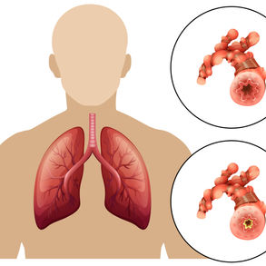 COPD - Chronisch obstruktive Lungenerkrankung