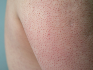 Treating Keratosis Pilaris