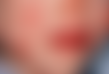 Brote de enfermedad grave Kawasaki símil en niños en Italia