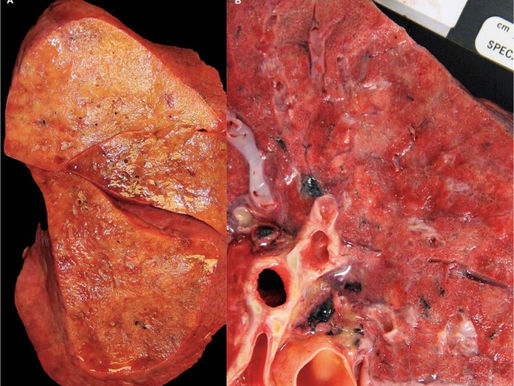 Examen postmortem de pacientes con covid-19