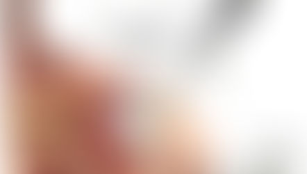 Descompresión subacromial artroscópica sin beneficio