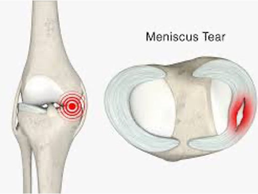 Ejercicio en casa beneficioso en rotura meniscal