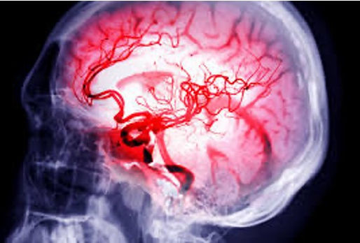 Asundexian en prevención secundaria del ACV