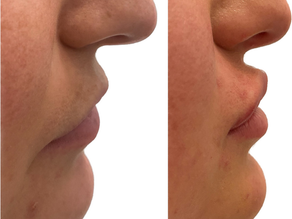 Are you looking for a more balanced facial profile?