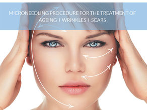 Microneedling with SkinPen