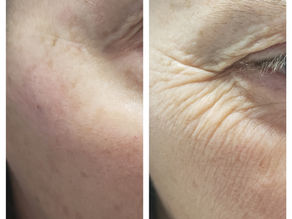 BOTOX Cosmetic® BIG Event Nov 16th