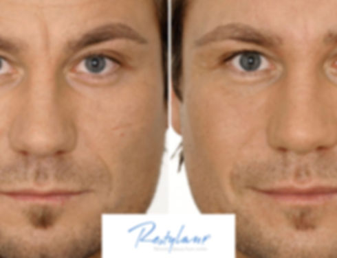img-treatments-facial-fillers-men-restyl