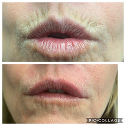 lip lines with filler