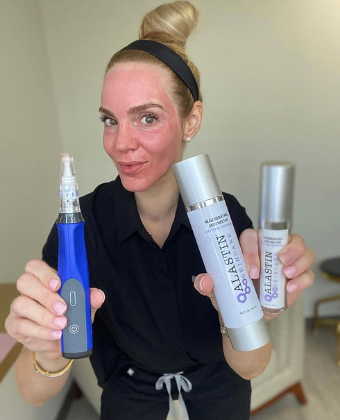 Picture of client holing Microneedling Skin Pen