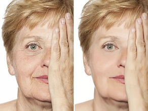 When Choosing Botox and Fillers is a Good Thing