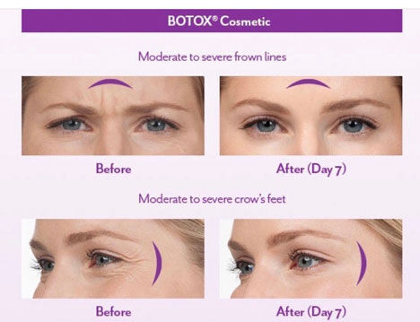 Here are a few Oakville Client and the before and after botox.
