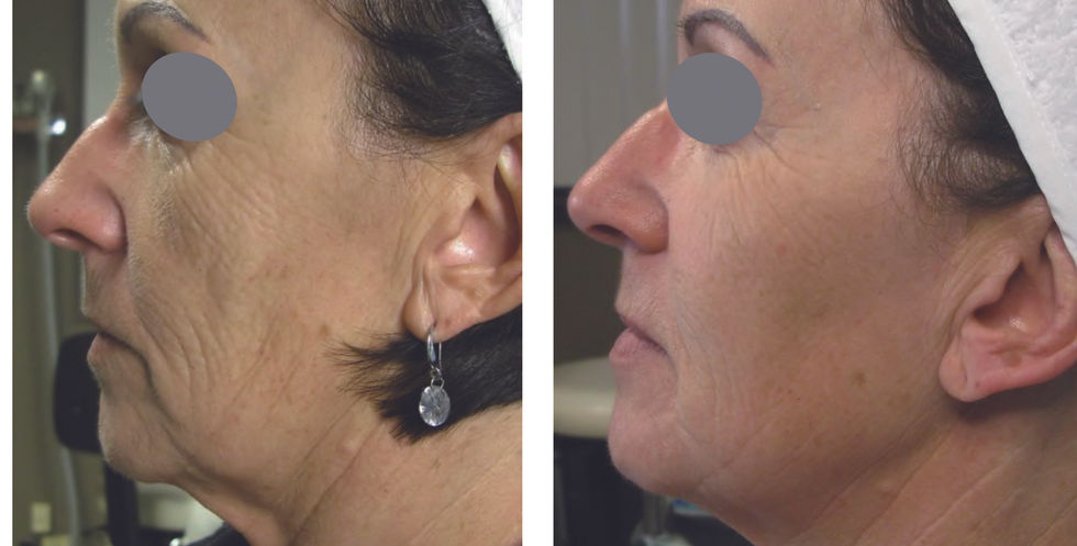 Tixel Treatment -Rejuvenation and Tightening