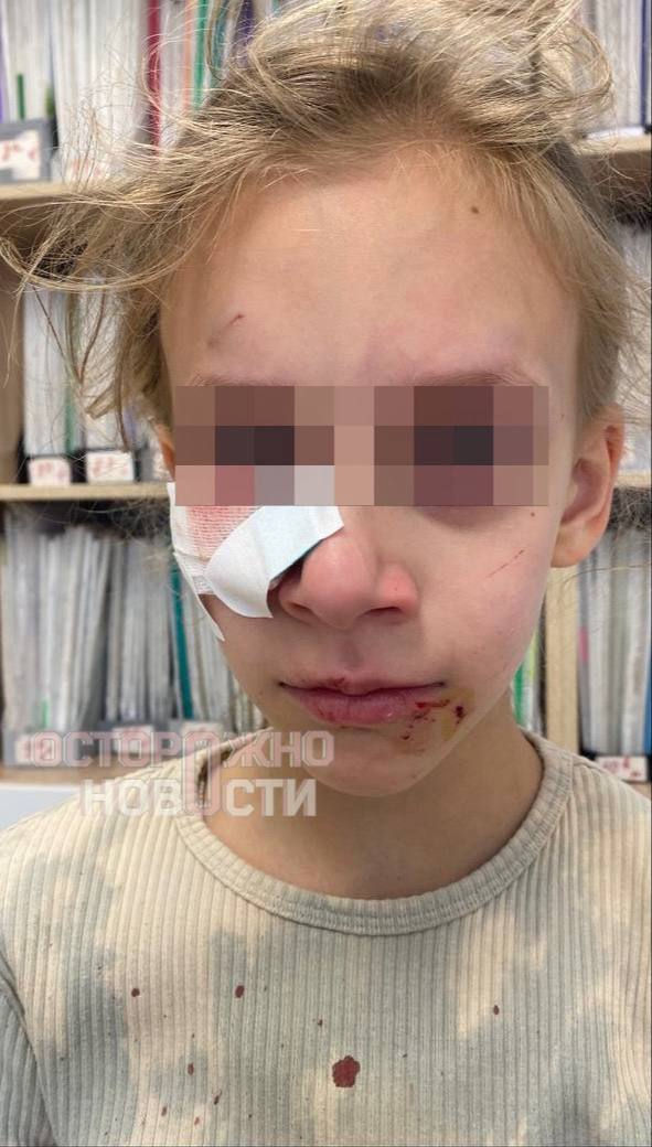 В Краснодаре бродячая собака напала на 8-летнюю школьницу в летнем лагере