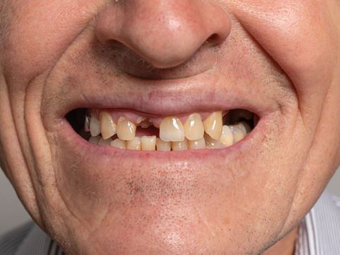 The Silent Epidemic: The Psychological Impact of Missing Teeth
