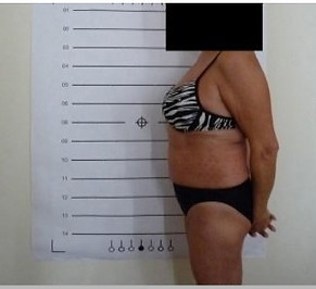 Lipo Light Fat Reduction|Reduced 2cm after one session |NYC Ease Medspa