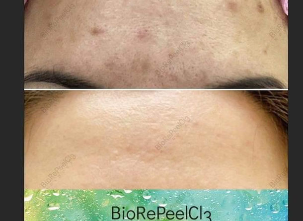 BioRePeel Before & After