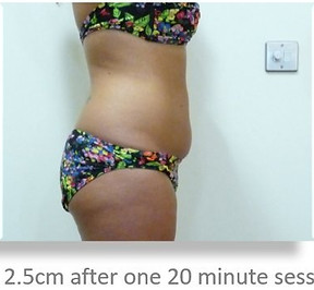 Lipo Light Fat Reduction|lose 2cm with One treatment|NYC Ease Medspa