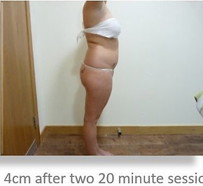 Lipo Light Fat Reduction|lose 2cm with One treatment|NYC Ease Medspa
