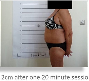 Lipo Light Fat Reduction|lose 2cm after One treatment|NYC Ease Medspa