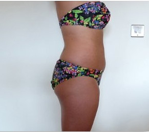 Lipo Light Fat Reduction|Reduced 2.5cm after one session|NYC Ease Medspa