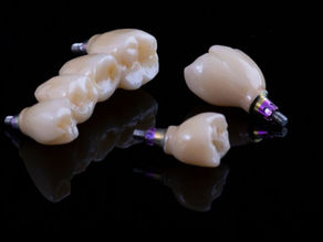Implantes Dentales: Recuperando la Sonrisa y la Confianza