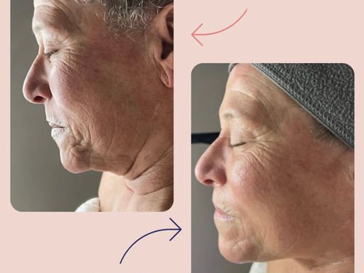 Experience Ageless Beauty with Cryoskin Facial at Dawn Amador Advanced Skin Therapy
