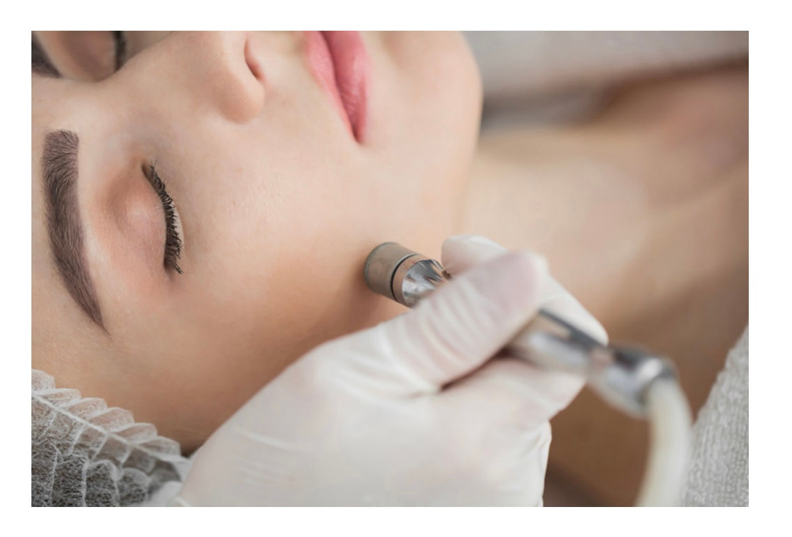 Microdermabrasion