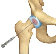 Hip Core Decompression