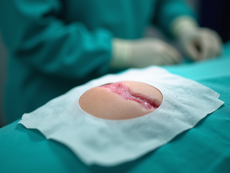 Post-surgical wound care for faster healing and fewer complications