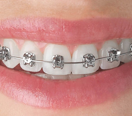 silver-braces.jpg