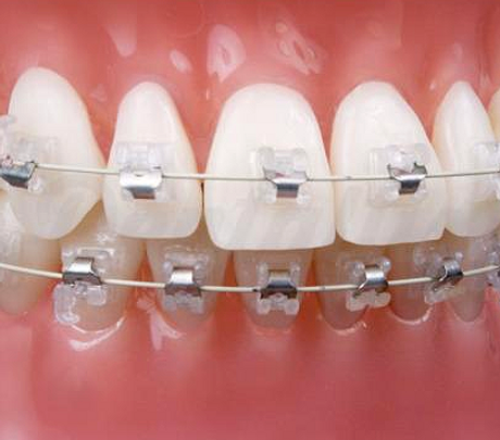 sensation-brackets-roth_0_edited.jpg