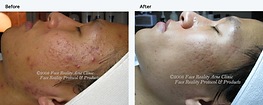 Leesburg, rezenerate, LED, Celluma, acne, anti-aging, skin treatments, be luminous skin studio, bodybrite nova, michelina, microdermabrasion, skin care, facial, skin, beauty, face reality, lash lift, elleebana, hydrafacial
