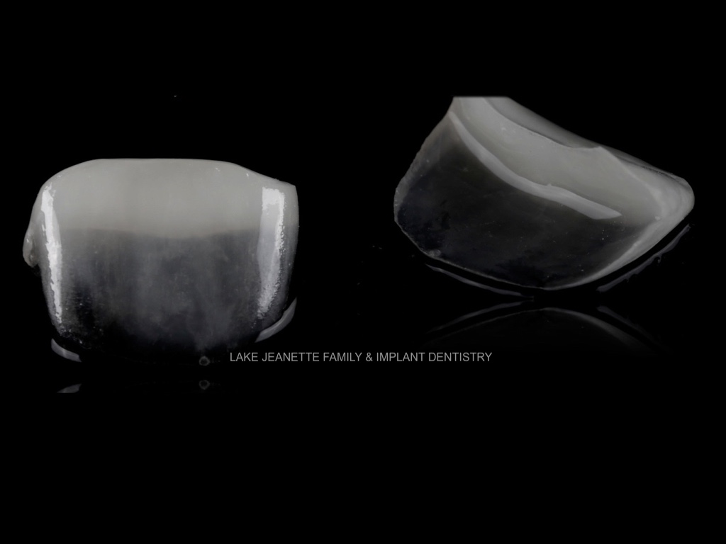 Porcelain veneers improving smile shape and color with natural esthetic results in Greensboro NC
