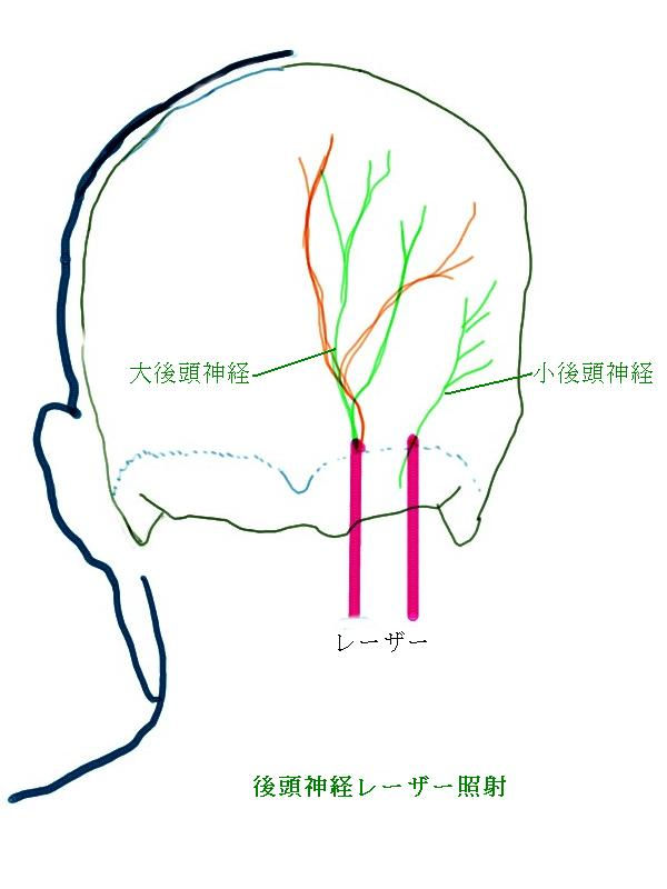 後頭神経痛 頭の後ろの痛み レーザー療法