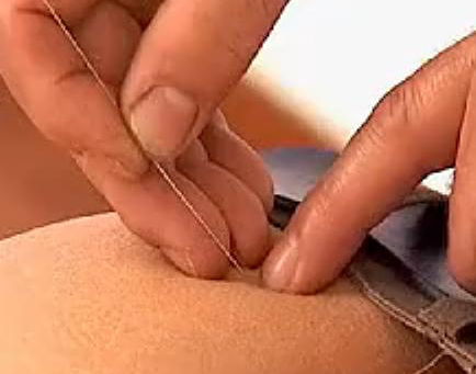 前立腺肥大症・慢性非細菌性前立腺炎に中国鍼
