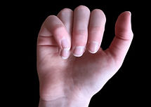 Rotation%20deformity_edited.jpg