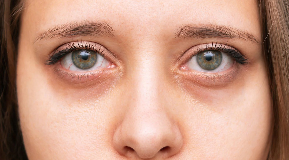 Saiba mais sobre olheiras