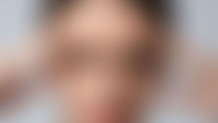 Migren Ağrısına Botoks Tedavisi