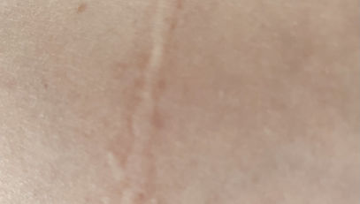 Narbenbehandlung