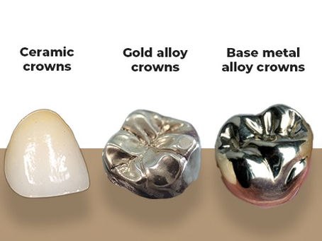 10 Dental Crown Materials Compared: Pros, Cons & UK Costs