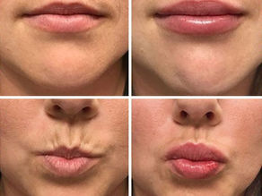 Lip Filler Aftercare Advice: 18 Essential Recovery Tips