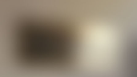 ADRENOLEUCODISTROFIA, FIBROSI CISTICA E OBESITA' GRAVE