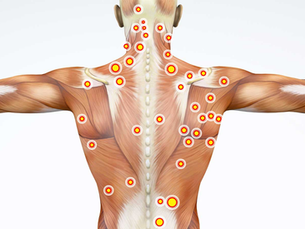 Medicare Guidelines for Billing and Coding: Trigger Point Injections Article A57751
