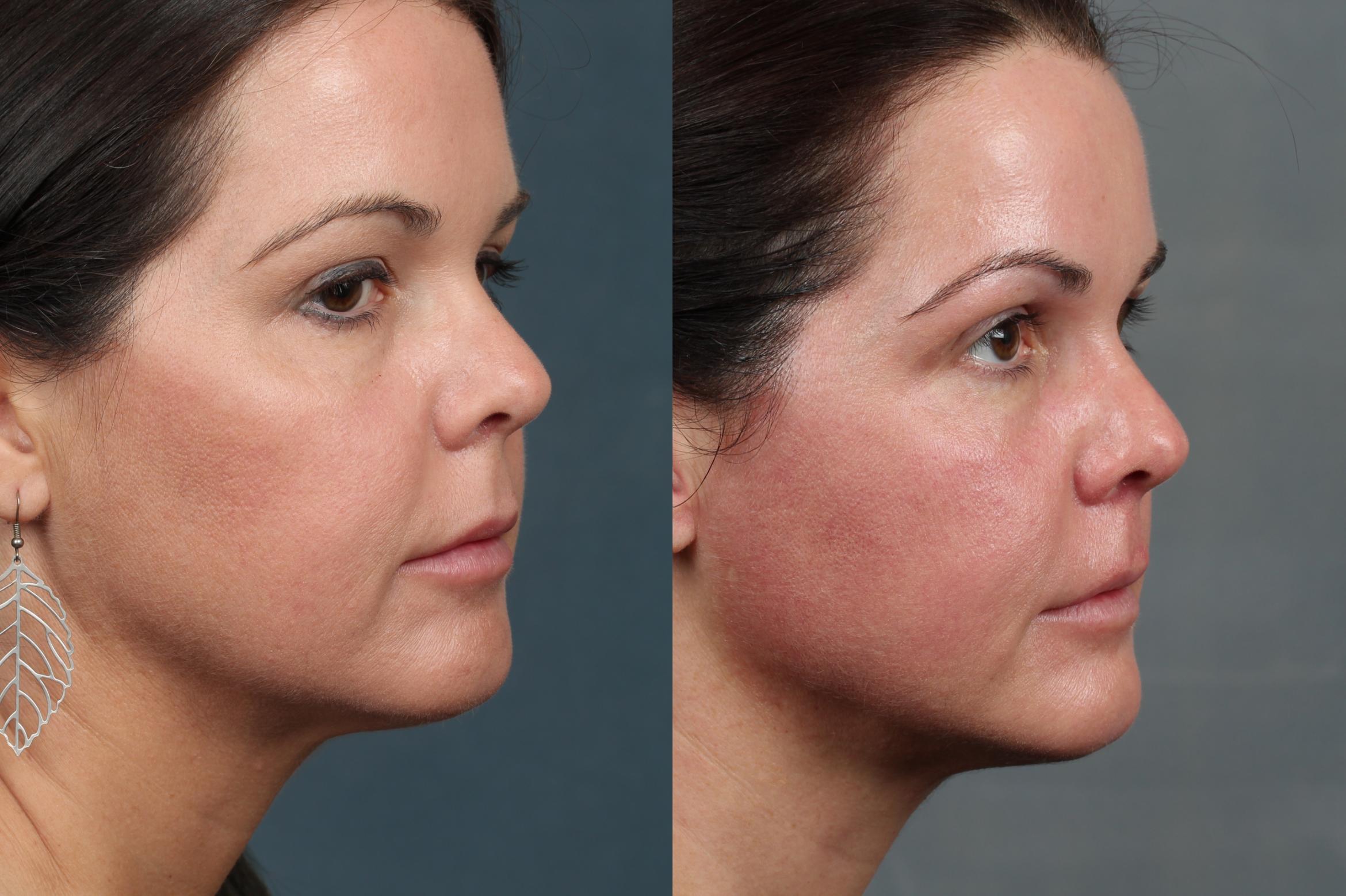 ultherapy.webp