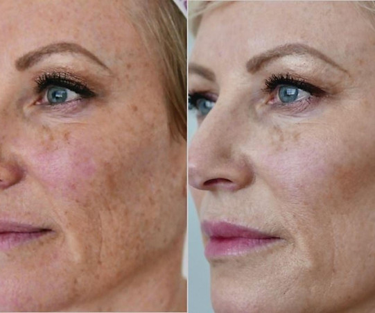 halo-laser-skin-resurfacing-249-left-oblique-detail.jpg