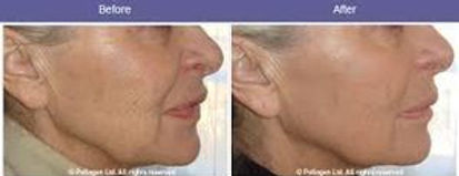 OxyGeneo results - Your Fabulous Face Aesthetics