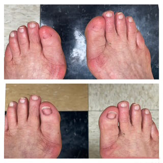 Toe reconstruction with restorative micropigmentation